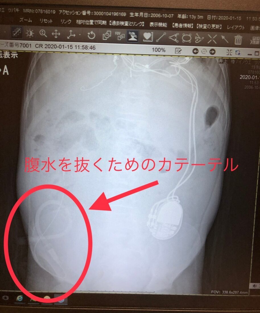 難治性腹水　在宅医療　医ケア児