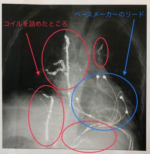 医ケア児　心臓病　余命宣告