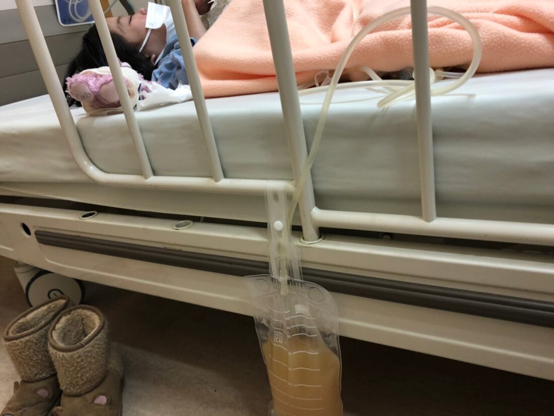 難治性腹水　在宅医療　医ケア児