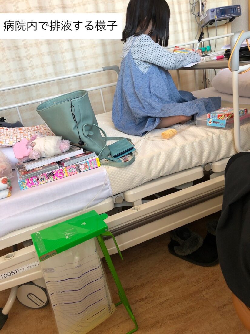 難治性腹水　在宅医療　医ケア児