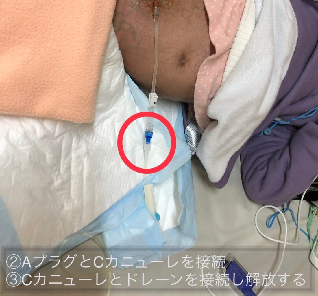 難治性腹水　在宅医療　医ケア児